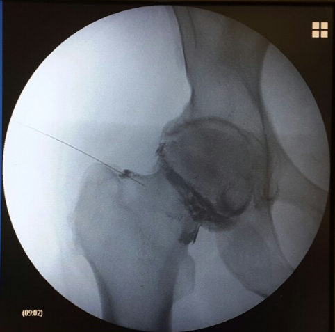 Hip injection cases - Dr Oikonomidis Lazaros Orthopaedic Surgeon